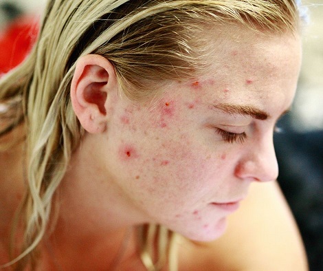 l'acné: comment en venir à bout?